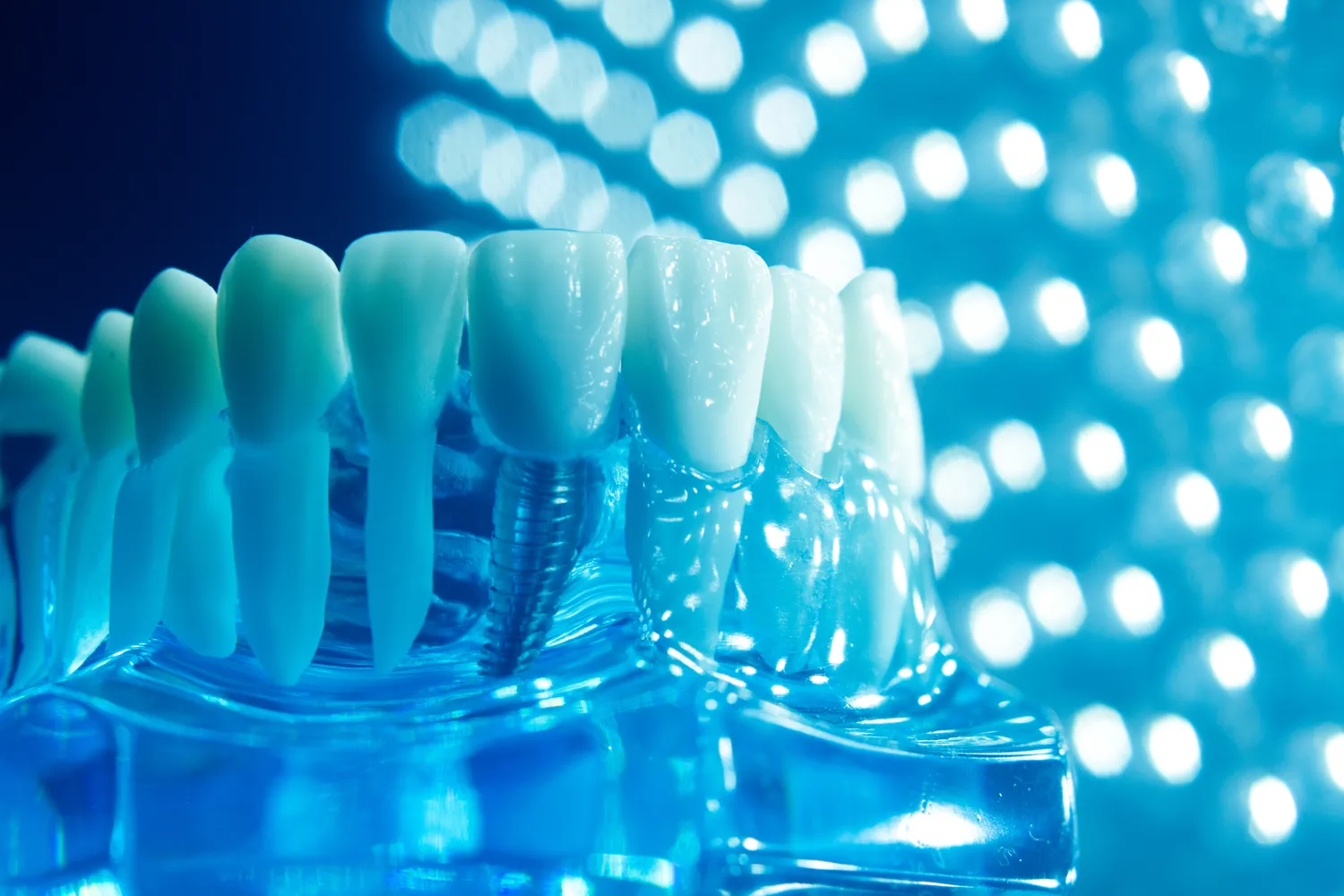 Kiedy jest za późno na leczenie kanałowe?