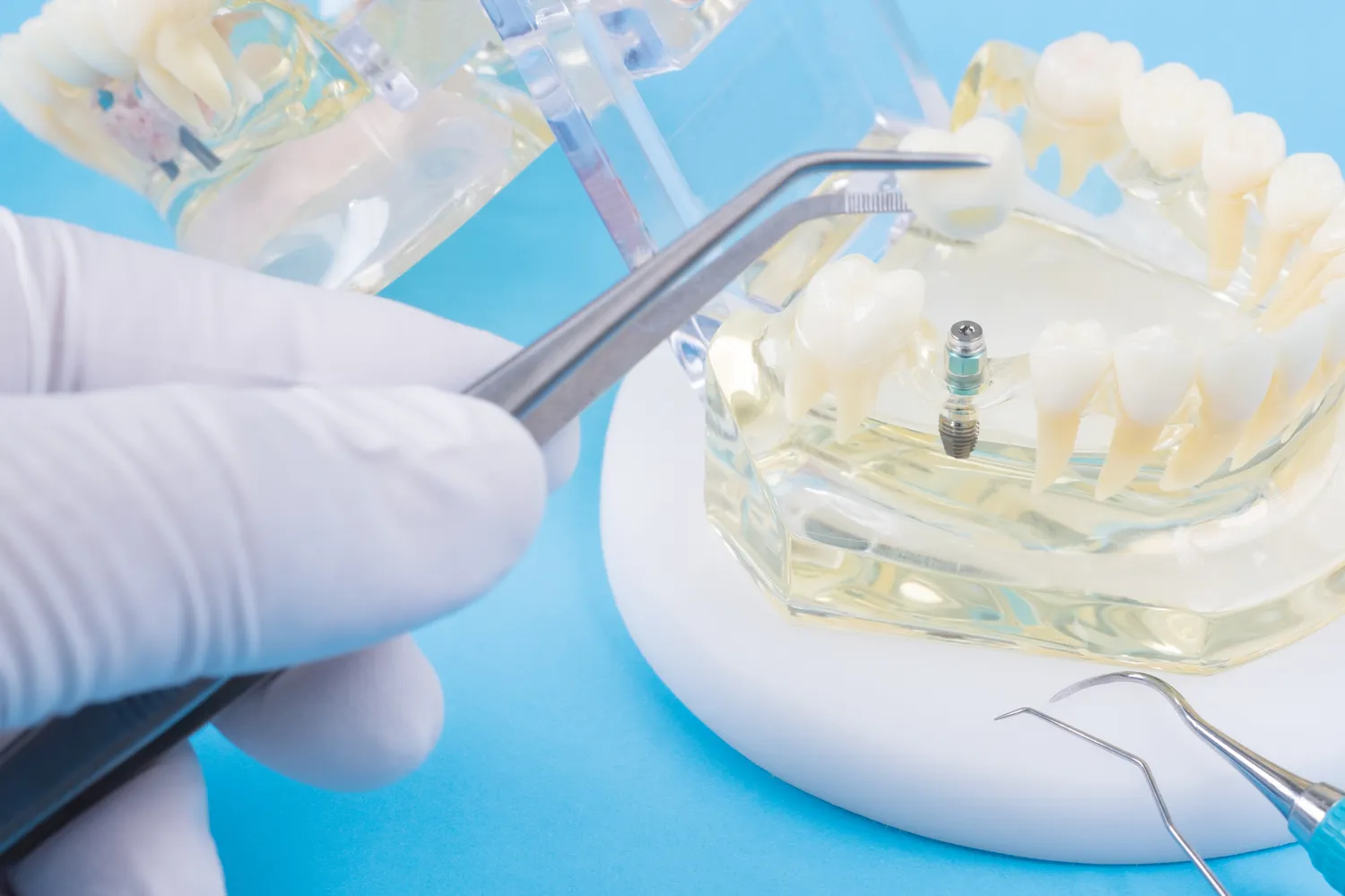 Leczenie kanałowe ile trwa?