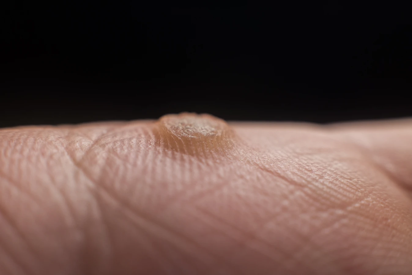 Co na kurzajki na palcu?